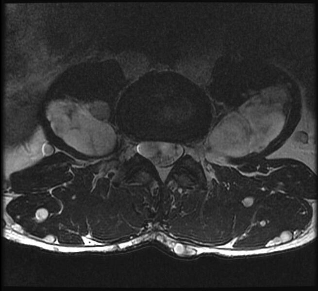 File:Neurofibromatosis type 1 (Radiopaedia 11671-12034 Axial 1).jpg