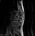 Neurofibromatosis type 2 - cranial and spinal involvement (Radiopaedia 5351-7112 B 3).jpg