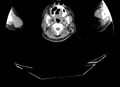Non-Hodgkin lymphoma involving seminal vesicles with development of interstitial pneumonitis during Rituximab therapy (Radiopaedia 32703-33677 Annotated CT 1).jpg