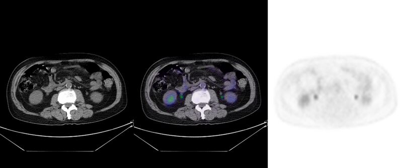 File:Non-Hodgkin lymphoma involving seminal vesicles with development of interstitial pneumonitis during Rituximab therapy (Radiopaedia 32703-33752 ax CT Fus PET 42).jpg