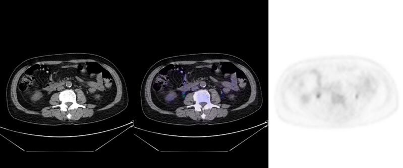 File:Non-Hodgkin lymphoma involving seminal vesicles with development of interstitial pneumonitis during Rituximab therapy (Radiopaedia 32703-33752 ax CT Fus PET 43).jpg