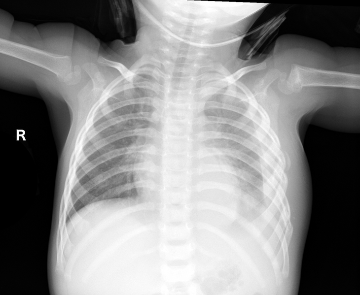 File:Non-accidental injury (Radiopaedia 47998-52793 Frontal 1).png
