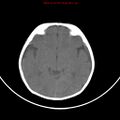 Non-accidental injury - bilateral subdural with acute blood (Radiopaedia 10236-10765 Axial non-contrast 10).jpg
