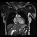 Non-compaction of the left ventricle (Radiopaedia 38868-41062 1CH SSFP CINE 6).jpg