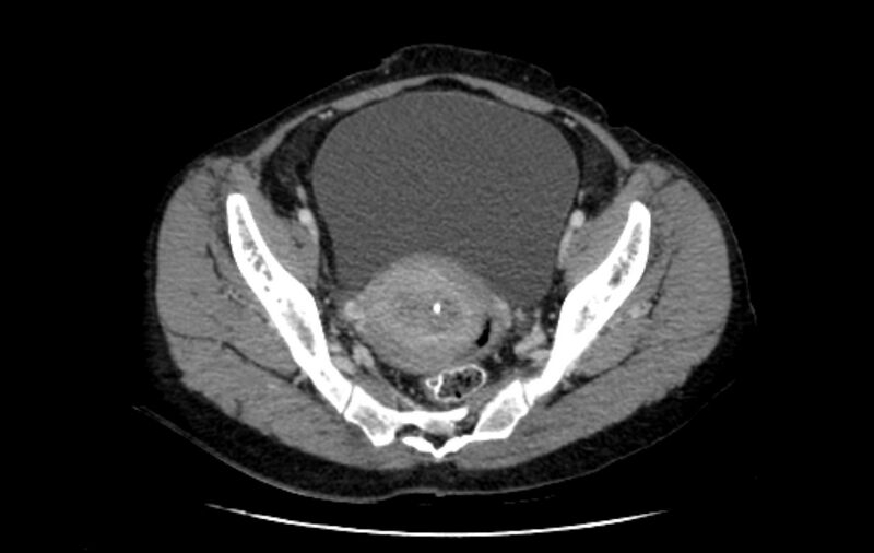 File:Non-puerperal uterine inversion (Radiopaedia 78343-91094 A 17).jpg