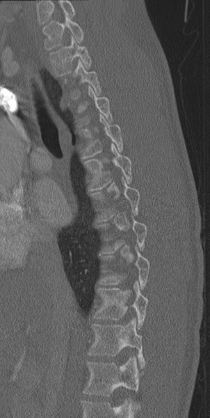 File:Normal CT thoracic spine (Radiopaedia 40181-42688 Sagittal bone window 43).png