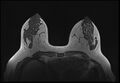 Normal breast MRI - dense breasts (Radiopaedia 80454-93850 Axial T1 89).jpg