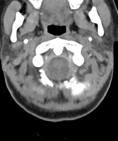 File:Normal cervical spine MRI (including Dixon) (Radiopaedia 42762-45926 Axial non-contrast 10).png