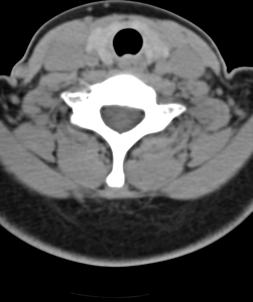 File:Normal cervical spine MRI (including Dixon) (Radiopaedia 42762-45926 Axial non-contrast 43).png