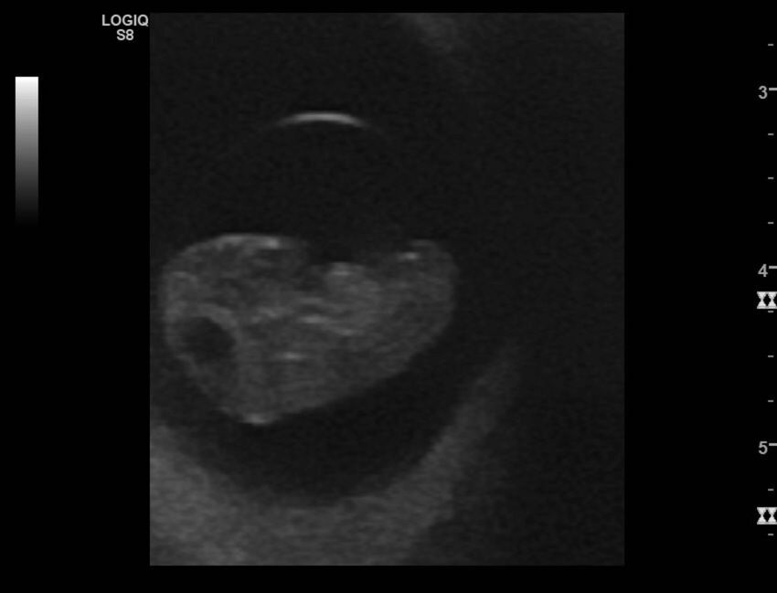 Normal early pregnancy - 8w0d (Radiopaedia 44715-48492 Longitudinal 23).jpg