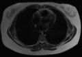 Normal liver MRI with Gadolinium (Radiopaedia 58913-66163 Axial T2 35).jpg