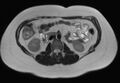 Normal liver MRI with Gadolinium (Radiopaedia 58913-66163 Axial T2 8).jpg