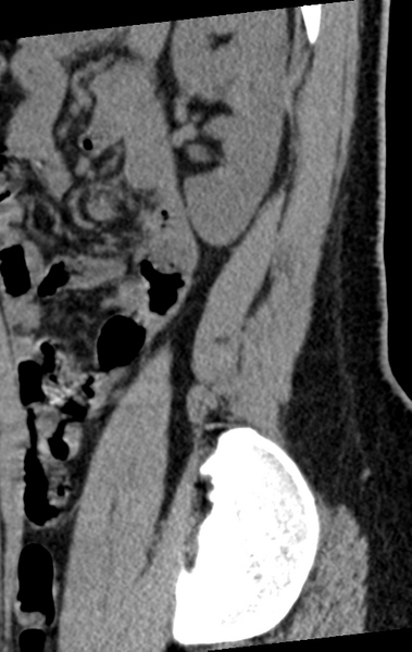 File:Normal lumbar spine CT (Radiopaedia 46533-50986 C 10).png