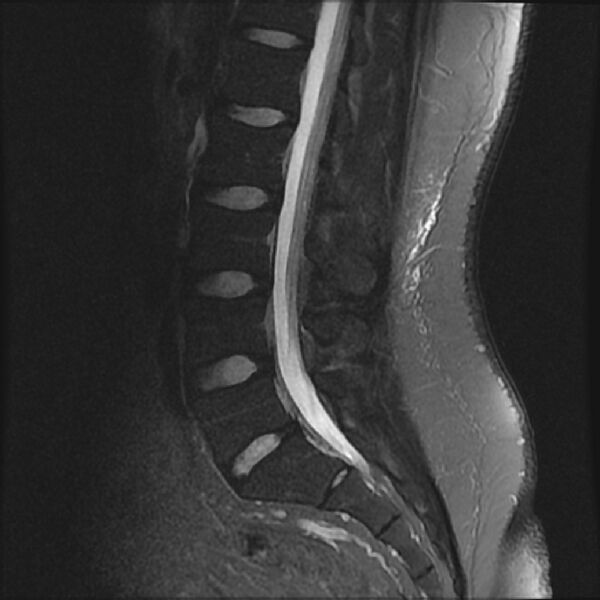 File:Normal lumbar spine MRI (Radiopaedia 43051-46311 Sagittal STIR 11).jpg