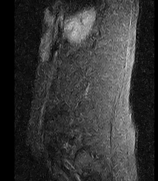 File:Normal lumbar spine MRI - low-field MRI scanner (Radiopaedia 40976-43699 Sagittal STIR 1).jpg