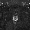Normal prostate (MRI) (Radiopaedia 29986-30535 Axial STIR 2).jpg