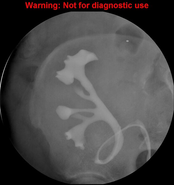 File:Normal retrograde pyelography of a native and transplant kidney (Radiopaedia 40480-43054 Transplant kidney 20).jpg