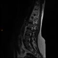 Normal spine MRI (Radiopaedia 77323-89408 Sagittal T2 10).jpg