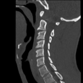 Normal trauma cervical spine (Radiopaedia 41017-43760 Sagittal bone window 17).png