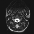 Normal trauma cervical spine (Radiopaedia 41017-43762 D 1).png