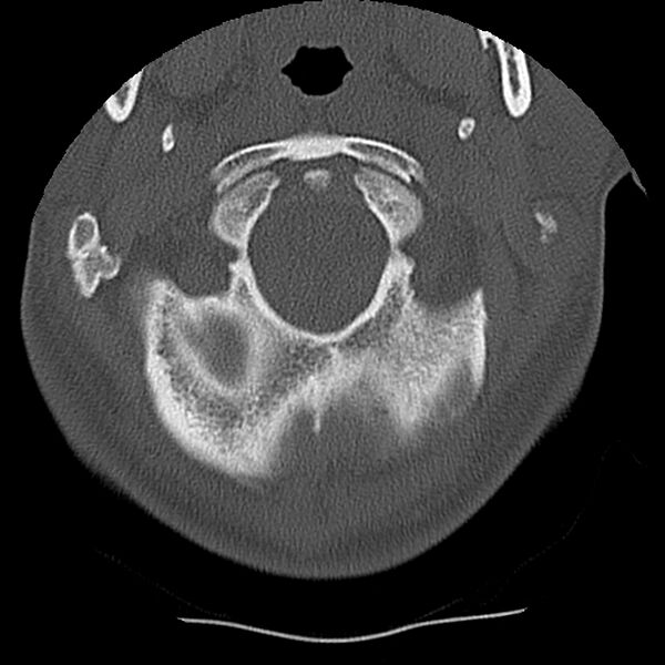 File:Normal trauma spine imaging (Radiopaedia 31753-32686 Axial bone window 5).jpg