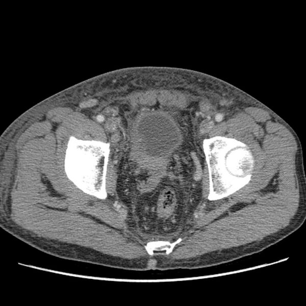 File:Obstructive bladder transitional cell carcinoma (Radiopaedia 9825-10410 A 31).jpg