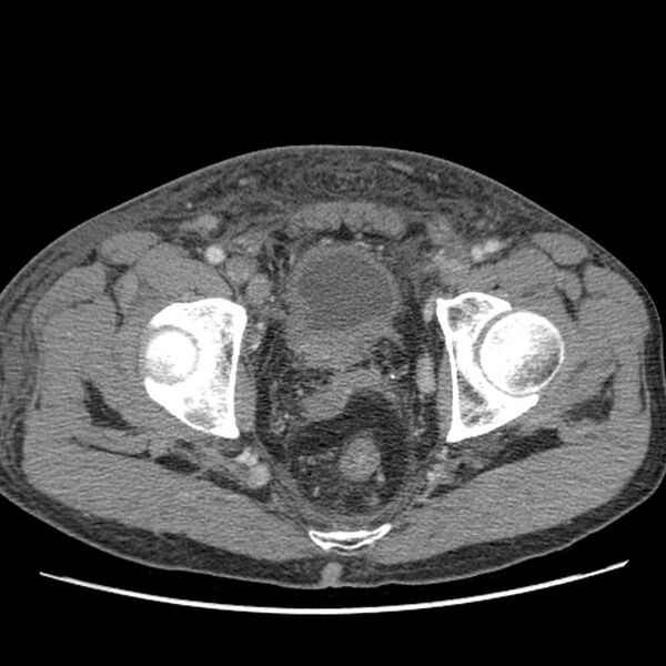 File:Obstructive bladder transitional cell carcinoma (Radiopaedia 9825-10410 A 32).jpg