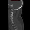 Occipital condyle fracture (Radiopaedia 18366-18208 Sagittal bone window 6).jpg