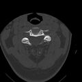 Occipital condyle fracture (Radiopaedia 31755-32691 Axial bone window 28).jpg