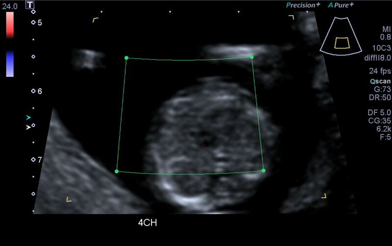 File:1st trimester nuchal-morphology ultrasound (Radiopaedia 44706-48477 Heart views cine with colour 24).jpg