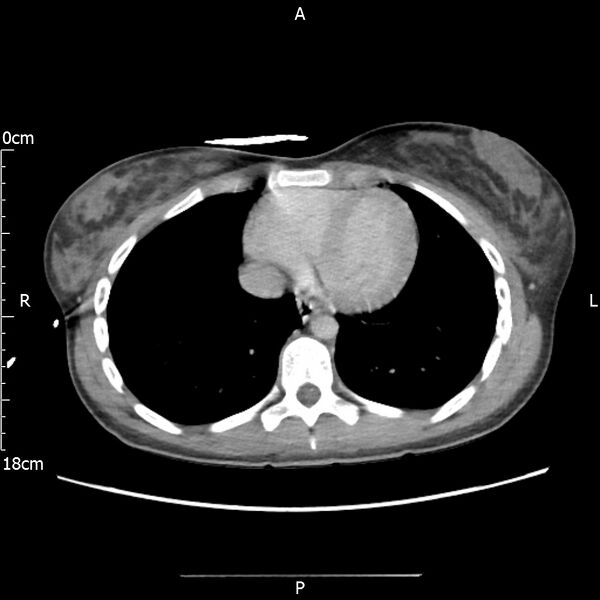 File:AAST grade IV kidney injury with CEUS follow-up (Radiopaedia 72353-82877 Axial C+ portal venous phase 1).jpg