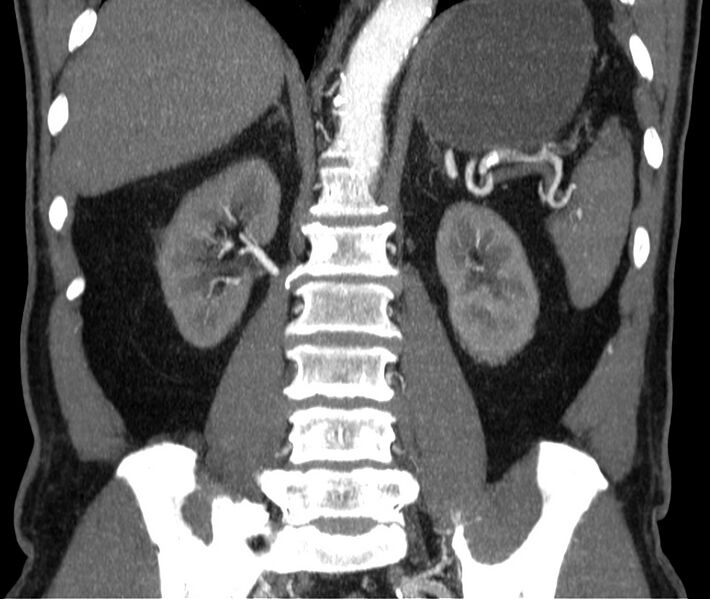 File:Abdominal aortic aneurysm (Radiopaedia 22421-22458 C 30).jpg