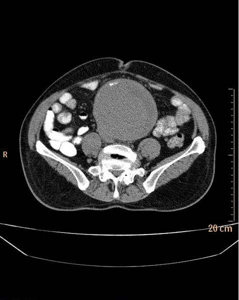 File:Abdominal aortic aneurysm (Radiopaedia 25985-26121 Axial non-contrast 19).jpg