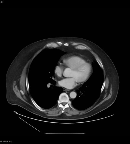File:Abdominal aortic aneurysm with intramural hematoma then rupture (Radiopaedia 50278-55631 Axial C+ arterial phase 33).jpg