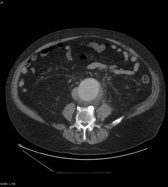 File:Abdominal aortic aneurysm with intramural hematoma then rupture (Radiopaedia 50278-55631 Axial C+ arterial phase 88).jpg