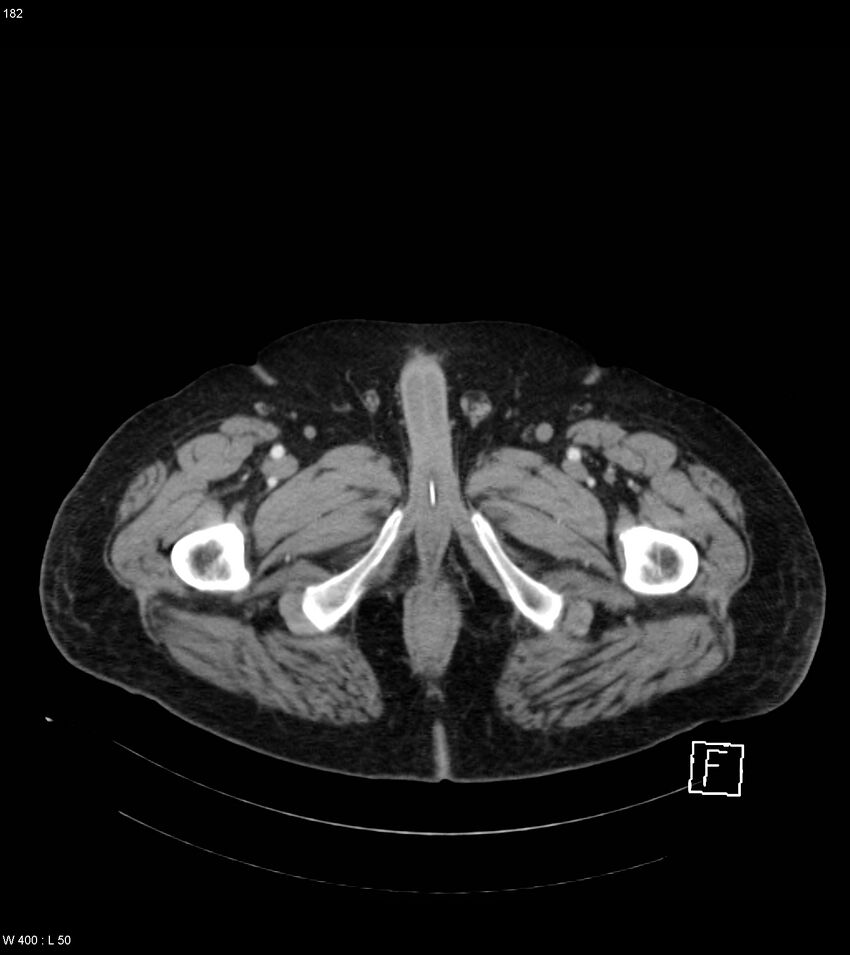 Abdominal aortic aneurysm with intramural hematoma then rupture (Radiopaedia 50278-55632 Axial C+ arterial phase 181).jpg