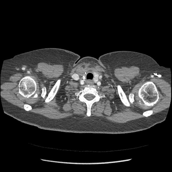File:Aberrant right subclavian and left vertebral arteries (Radiopaedia 43467-46847 Axial C+ portal venous phase 2).jpg