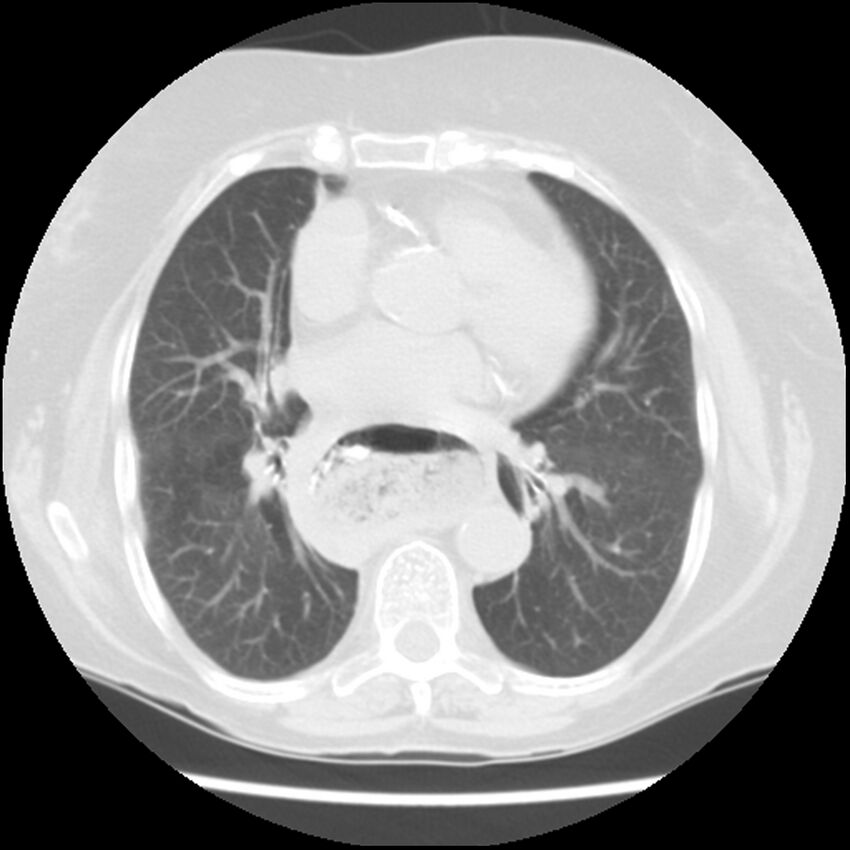 Achalasia (Radiopaedia 44094-47649 Axial lung window 33).jpg