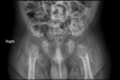Achondroplasia (pelvis) (Radiopaedia 61386).PNG