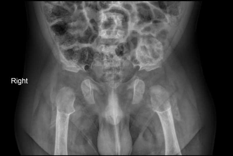 File:Achondroplasia (pelvis) (Radiopaedia 61386).PNG