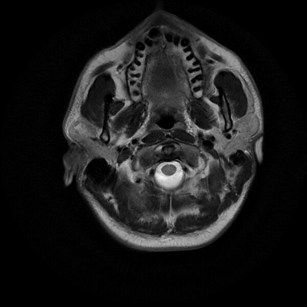 File:Acoustic schwannoma - intracanalicular (Radiopaedia 37247-39024 Axial T2 1).jpg