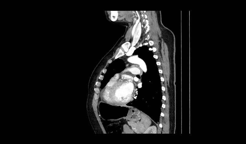 File:Acquired tracheo-esophageal fistula (Radiopaedia 51356-57103 Sagittal C+ arterial phase 4).jpg
