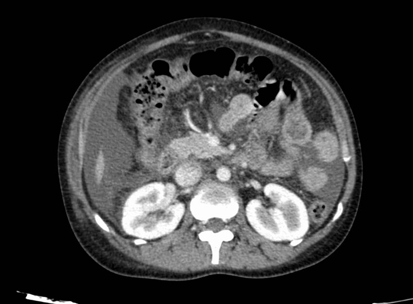 Acute Budd-Chiari syndrome (Radiopaedia 60858-68638 Axial C+ portal venous phase 125).jpg
