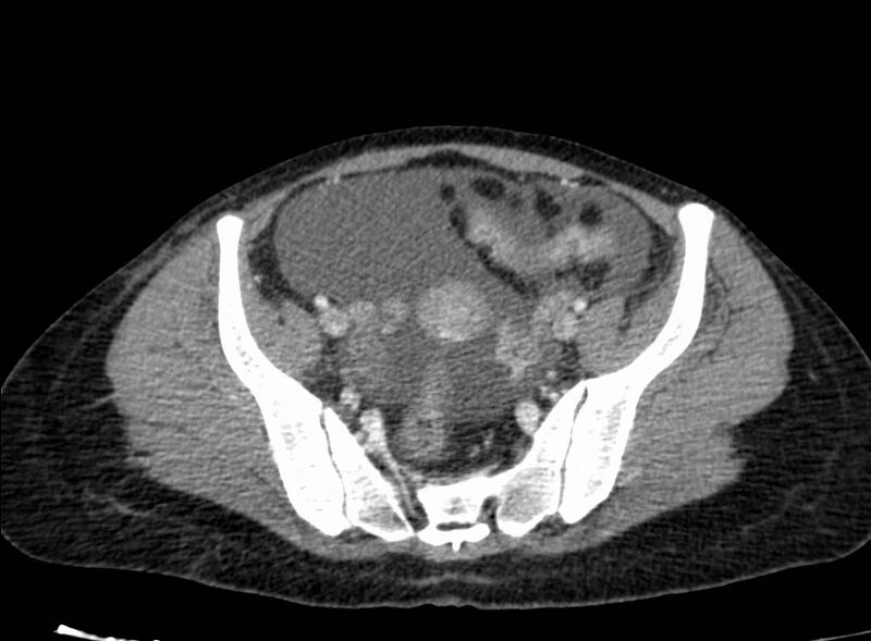 File:Acute Budd-Chiari syndrome (Radiopaedia 60858-68638 Axial C+ portal venous phase 243).jpg