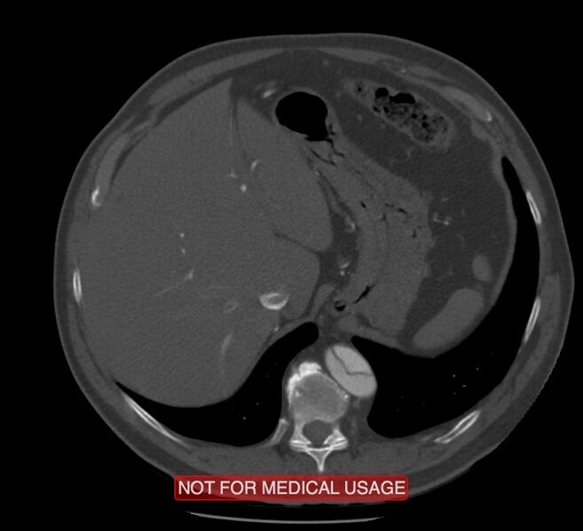 File:Acute aortic dissection - Stanford type A (Radiopaedia 40661-43285 Axial C+ arterial phase 72).jpg
