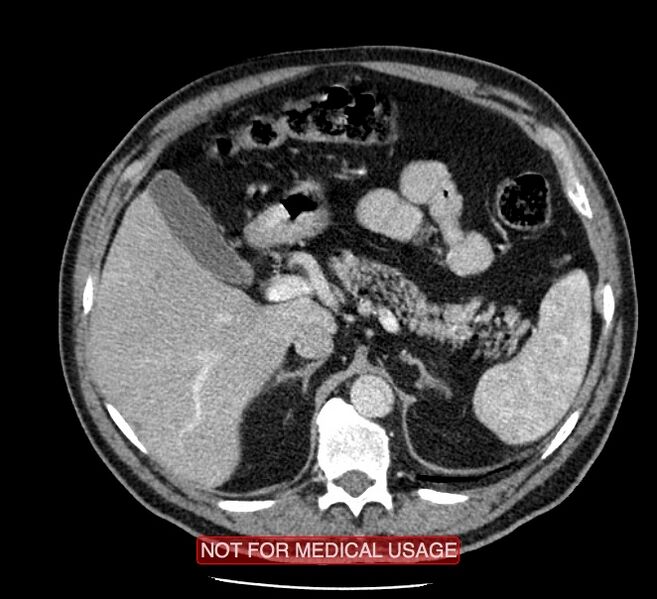 File:Acute aortic dissection - Stanford type A (Radiopaedia 40661-43285 Axial C+ portal venous phase 77).jpg