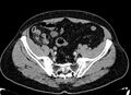 Acute appendicitis (Radiopaedia 13030-13091 Axial non-contrast 55).jpg