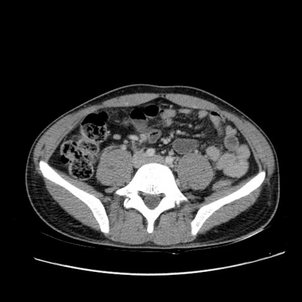 File:Acute appendicitis (Radiopaedia 27049-27227 Axial C+ portal venous phase 47).jpg