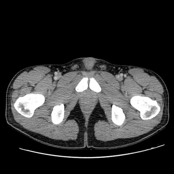 File:Acute appendicitis (Radiopaedia 27049-27227 Axial C+ portal venous phase 80).jpg