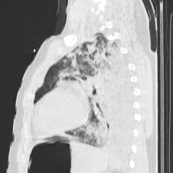 File:Acute aspiration pneumonitis (Radiopaedia 33605-34703 Sagittal lung window 58).jpg